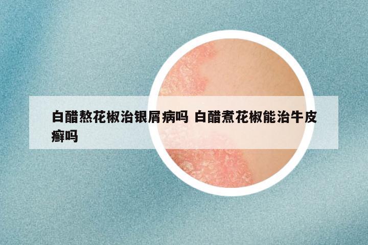 白醋熬花椒治银屑病吗 白醋煮花椒能治牛皮癣吗