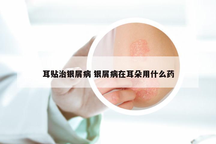 耳贴治银屑病 银屑病在耳朵用什么药