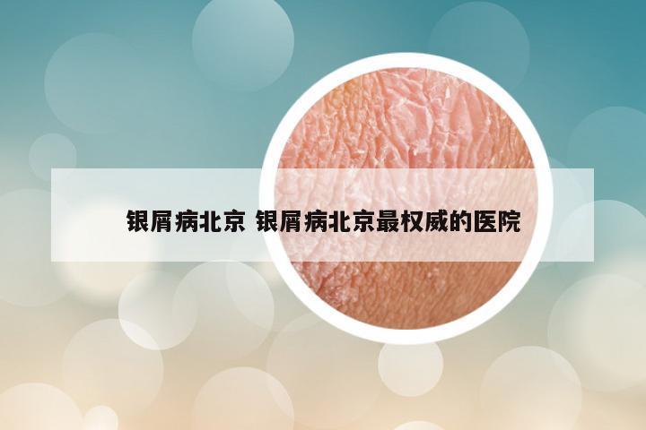 银屑病北京 银屑病北京最权威的医院