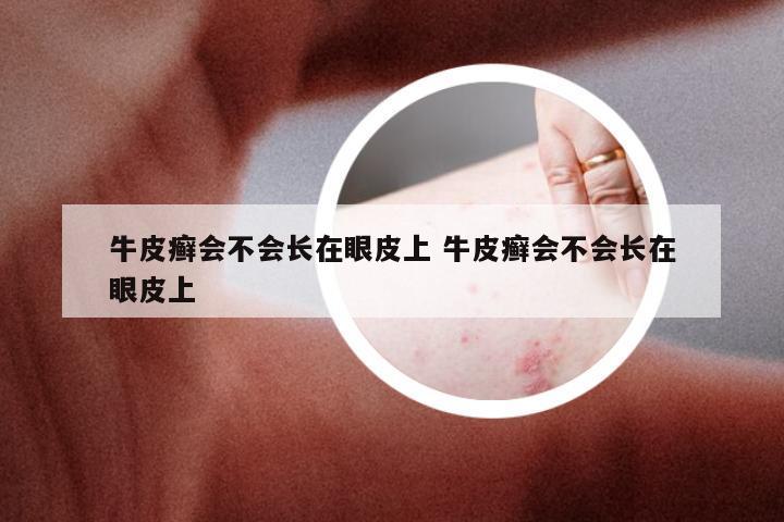 牛皮癣会不会长在眼皮上 牛皮癣会不会长在眼皮上