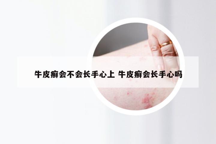 牛皮癣会不会长手心上 牛皮癣会长手心吗