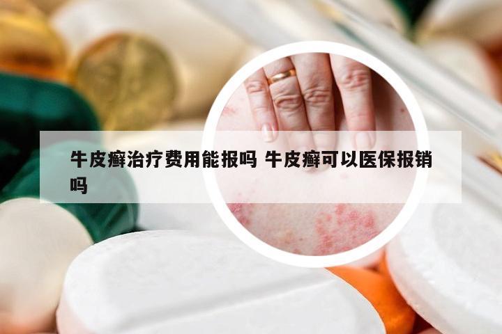 牛皮癣治疗费用能报吗 牛皮癣可以医保报销吗