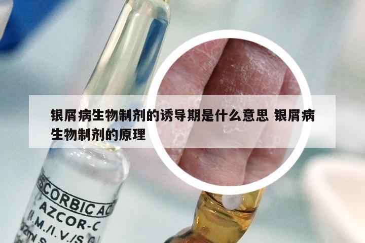 银屑病生物制剂的诱导期是什么意思 银屑病生物制剂的原理