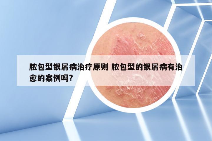 脓包型银屑病治疗原则 脓包型的银屑病有治愈的案例吗?