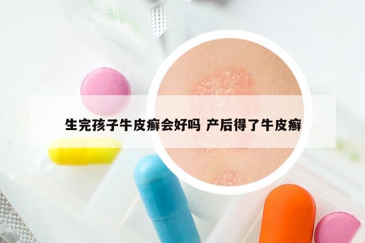 生完孩子牛皮癣会好吗 产后得了牛皮癣