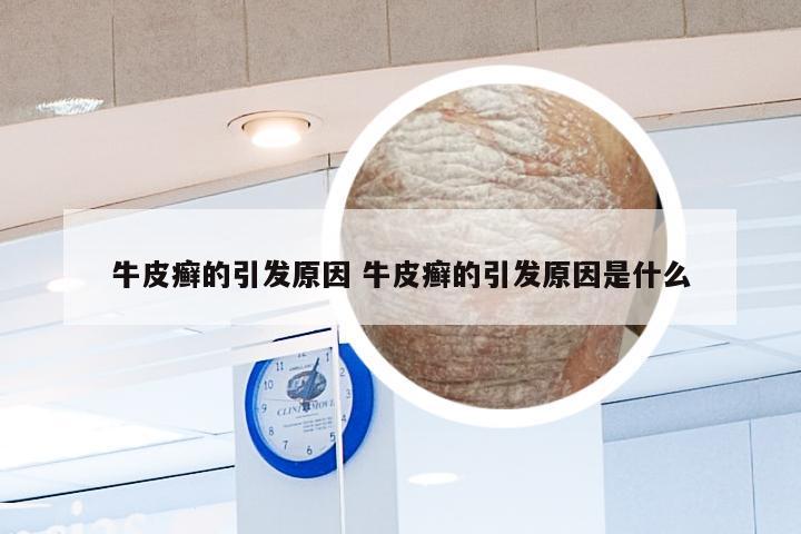 牛皮癣的引发原因 牛皮癣的引发原因是什么