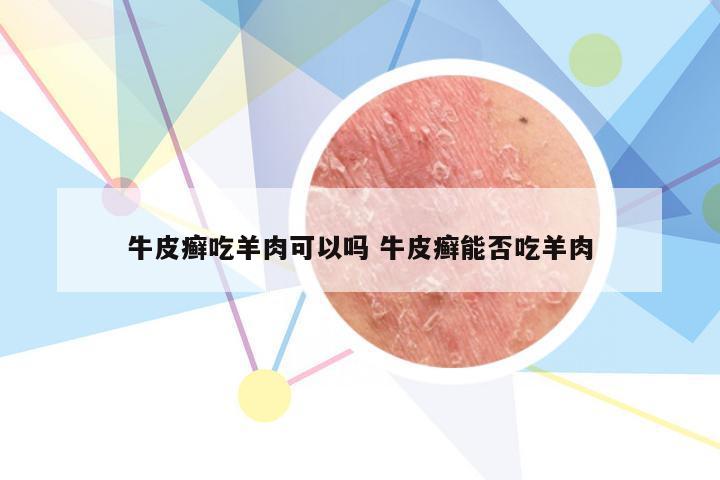 牛皮癣吃羊肉可以吗 牛皮癣能否吃羊肉