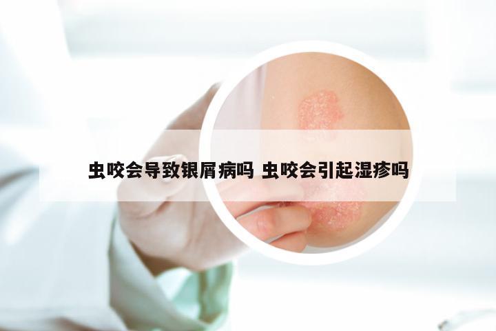 虫咬会导致银屑病吗 虫咬会引起湿疹吗