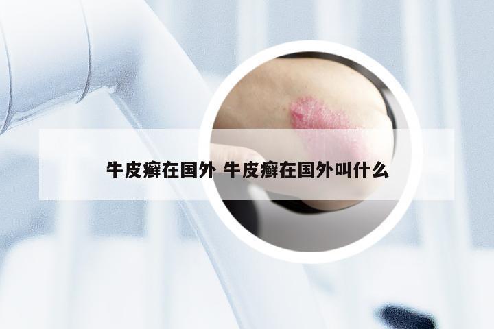 牛皮癣在国外 牛皮癣在国外叫什么