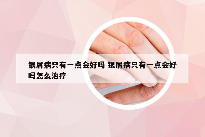 银屑病只有一点会好吗 银屑病只有一点会好吗怎么治疗