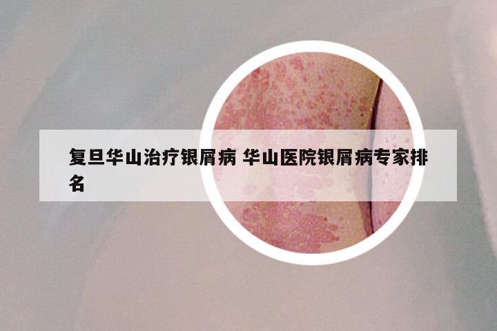 复旦华山治疗银屑病 华山医院银屑病专家排名