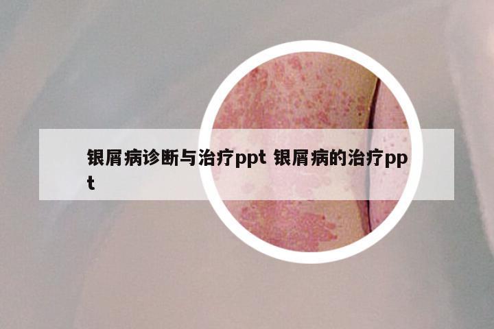 银屑病诊断与治疗ppt 银屑病的治疗ppt