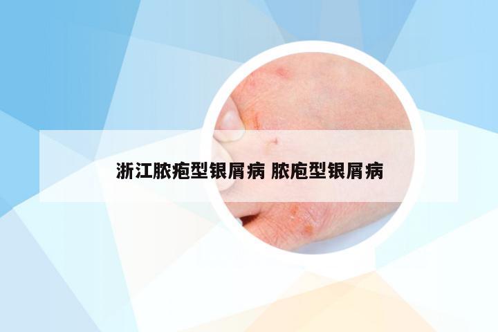 浙江脓疱型银屑病 脓庖型银屑病