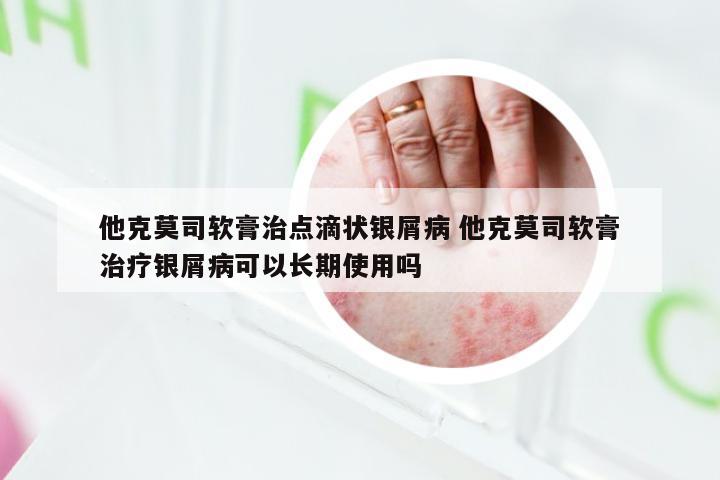他克莫司软膏治点滴状银屑病 他克莫司软膏治疗银屑病可以长期使用吗