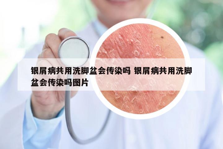 银屑病共用洗脚盆会传染吗 银屑病共用洗脚盆会传染吗图片