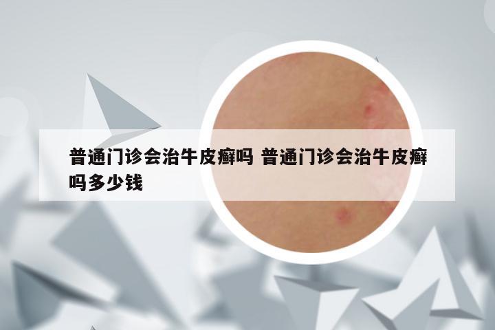 普通门诊会治牛皮癣吗 普通门诊会治牛皮癣吗多少钱