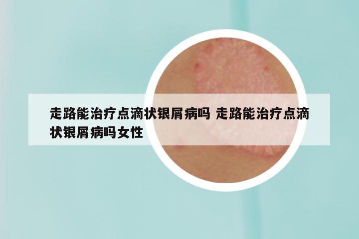 走路能治疗点滴状银屑病吗 走路能治疗点滴状银屑病吗女性
