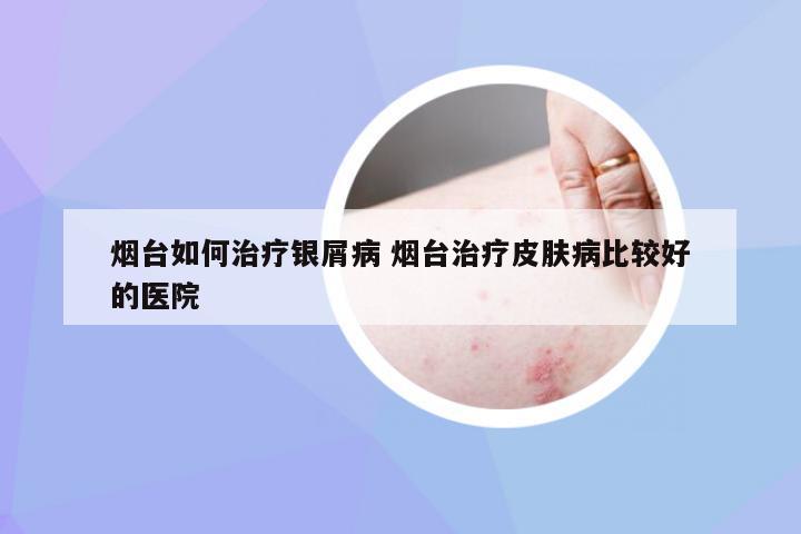 烟台如何治疗银屑病 烟台治疗皮肤病比较好的医院