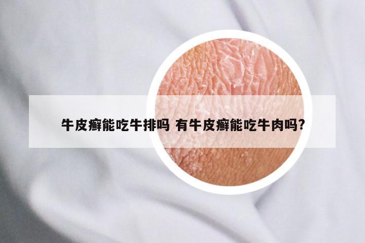 牛皮癣能吃牛排吗 有牛皮癣能吃牛肉吗?