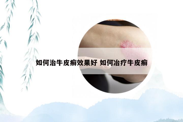 如何治牛皮癣效果好 如何冶疗牛皮癣