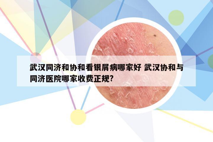 武汉同济和协和看银屑病哪家好 武汉协和与同济医院哪家收费正规?
