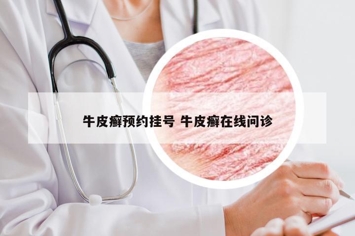 牛皮癣预约挂号 牛皮癣在线问诊