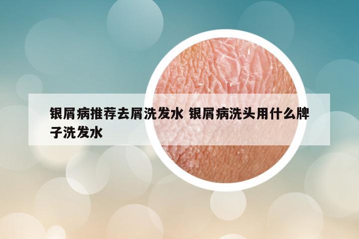 银屑病推荐去屑洗发水 银屑病洗头用什么牌子洗发水