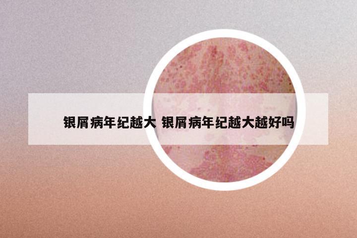 银屑病年纪越大 银屑病年纪越大越好吗