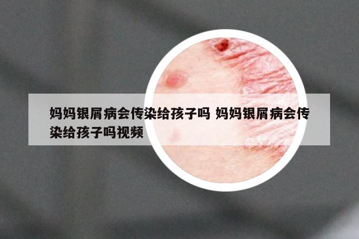 妈妈银屑病会传染给孩子吗 妈妈银屑病会传染给孩子吗视频