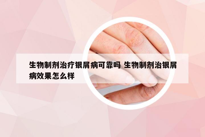 生物制剂治疗银屑病可靠吗 生物制剂治银屑病效果怎么样