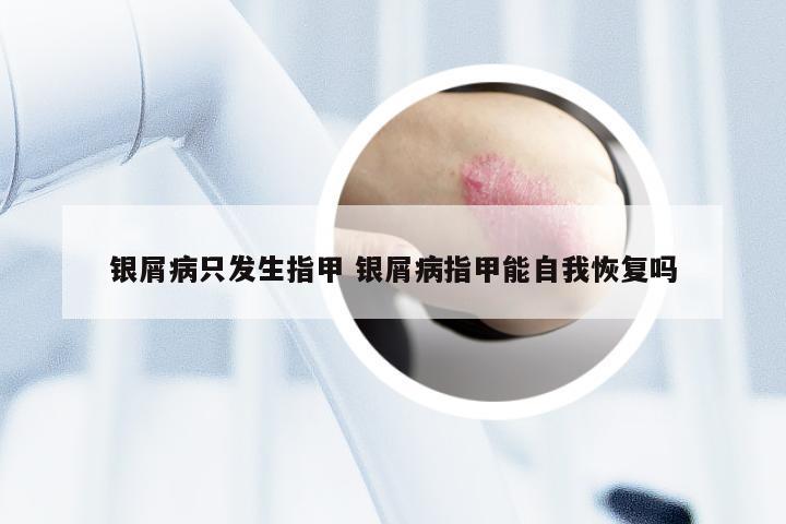 银屑病只发生指甲 银屑病指甲能自我恢复吗