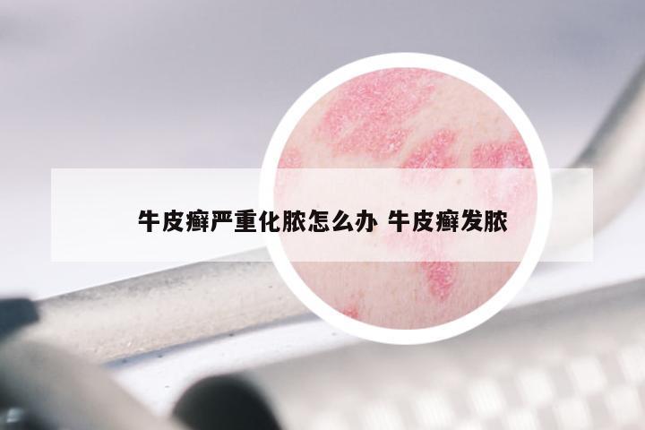 牛皮癣严重化脓怎么办 牛皮癣发脓