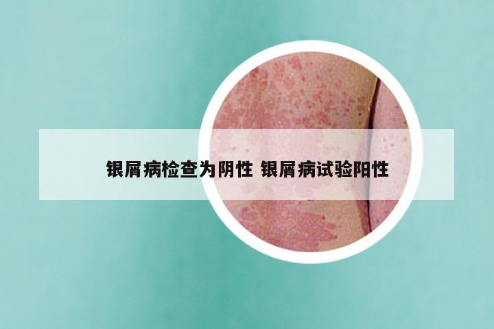银屑病检查为阴性 银屑病试验阳性