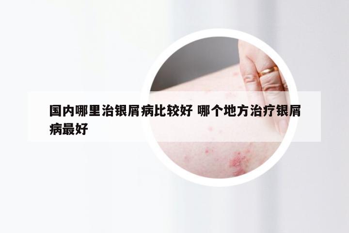 国内哪里治银屑病比较好 哪个地方治疗银屑病最好