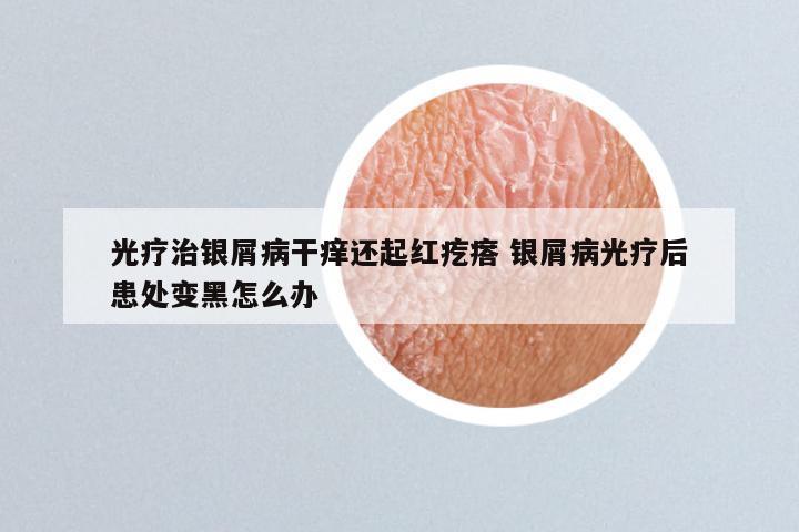 光疗治银屑病干痒还起红疙瘩 银屑病光疗后患处变黑怎么办