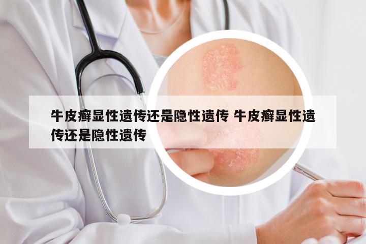 牛皮癣显性遗传还是隐性遗传 牛皮癣显性遗传还是隐性遗传