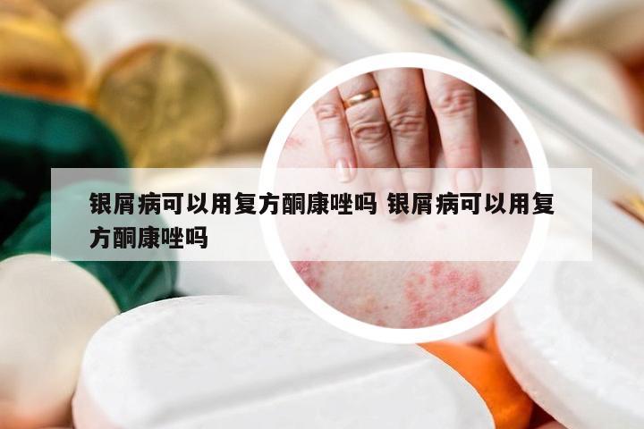 银屑病可以用复方酮康唑吗 银屑病可以用复方酮康唑吗