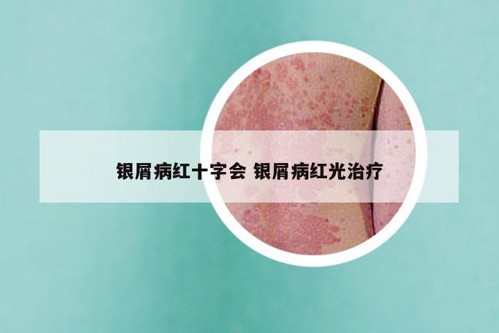 银屑病红十字会 银屑病红光治疗