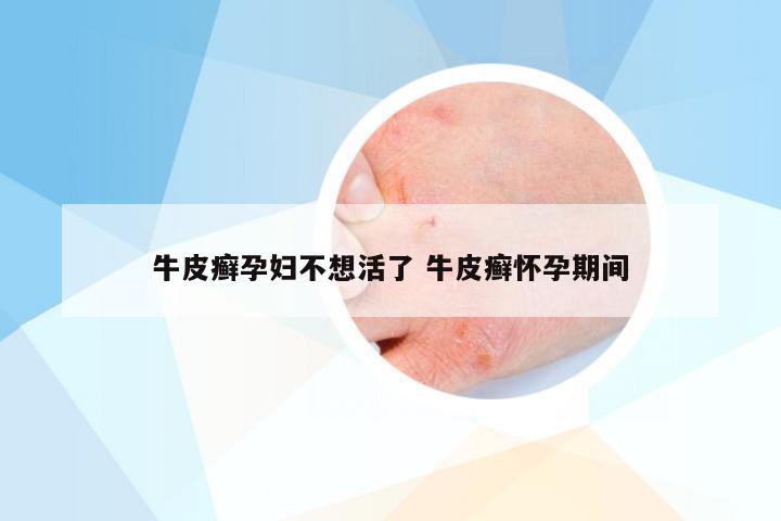牛皮癣孕妇不想活了 牛皮癣怀孕期间