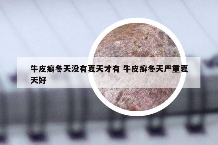 牛皮癣冬天没有夏天才有 牛皮癣冬天严重夏天好