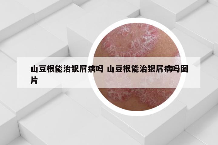 山豆根能治银屑病吗 山豆根能治银屑病吗图片