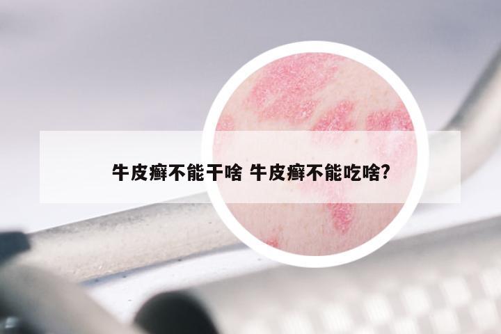 牛皮癣不能干啥 牛皮癣不能吃啥?