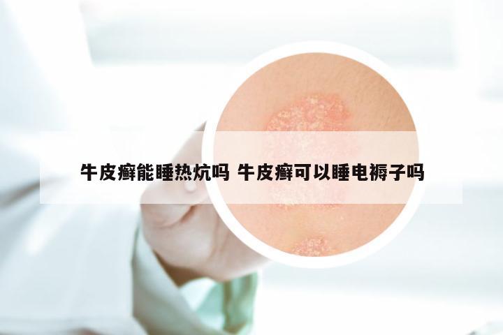 牛皮癣能睡热炕吗 牛皮癣可以睡电褥子吗