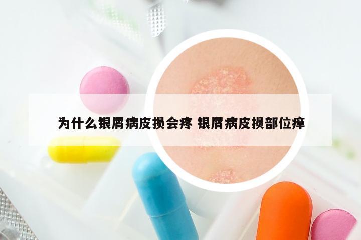 为什么银屑病皮损会疼 银屑病皮损部位痒
