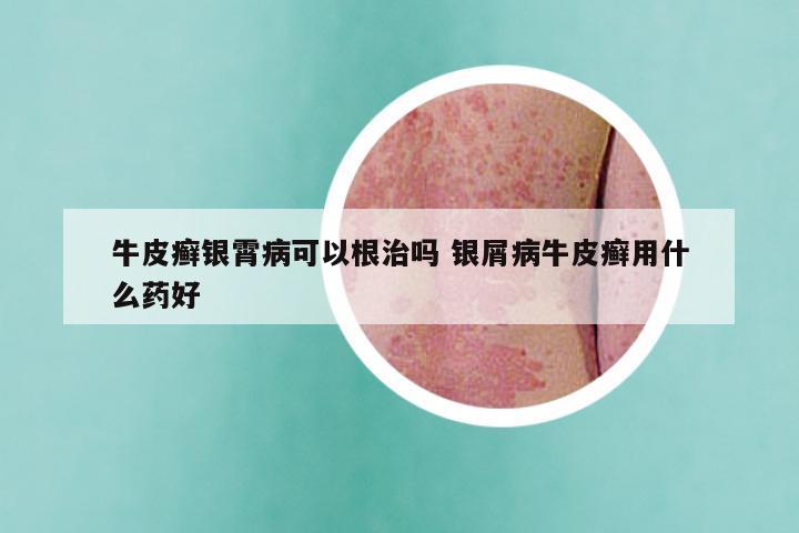 牛皮癣银霄病可以根治吗 银屑病牛皮癣用什么药好