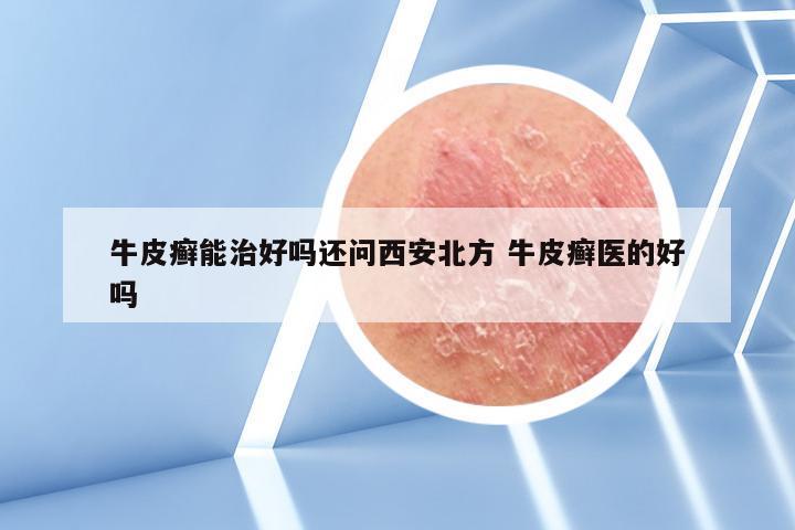 牛皮癣能治好吗还问西安北方 牛皮癣医的好吗
