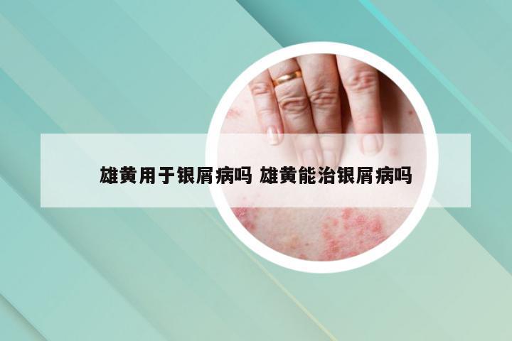 雄黄用于银屑病吗 雄黄能治银屑病吗