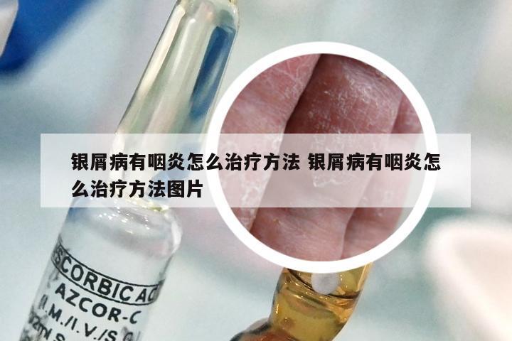 银屑病有咽炎怎么治疗方法 银屑病有咽炎怎么治疗方法图片