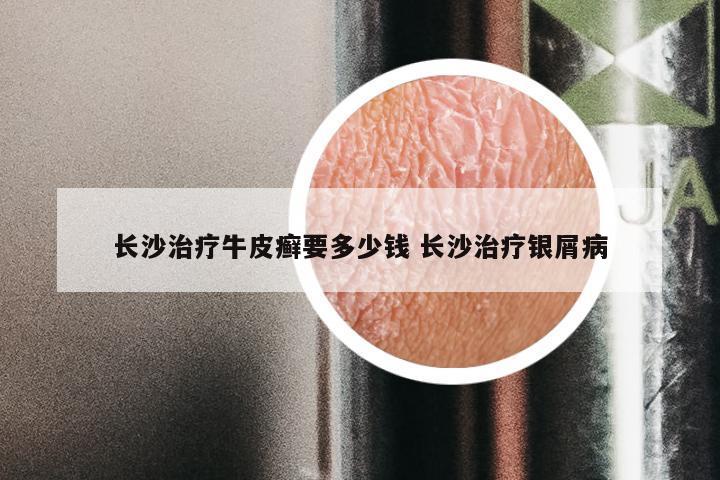 长沙治疗牛皮癣要多少钱 长沙治疗银屑病