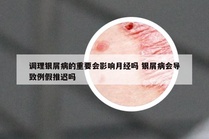 调理银屑病的重要会影响月经吗 银屑病会导致例假推迟吗